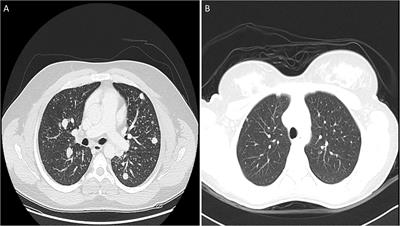 Predictive risk factors for distant metastasis in pediatric differentiated thyroid cancer from Saudi Arabia